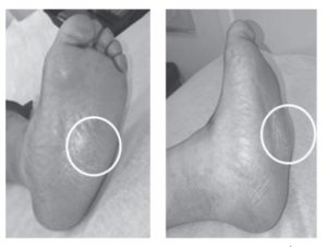 糖尿病の足病変 足病変の原因と壊疽 潰瘍予防のフットケアを含めた解説 名古屋糖尿病内科 アスクレピオス診療院 名東区の糖尿病専門医